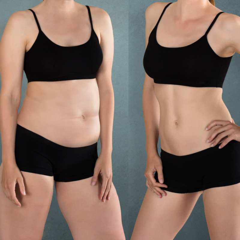 Does Fat Freezing at Home Work? DIY Devices vs Professional Cryolipolysis 2 before and after Cryolipolysis Sherborne