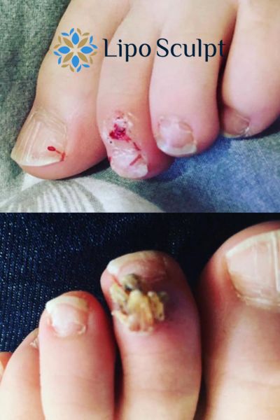 Wart removal customer results from Lipo Sculpt Sherborne